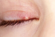 Какая мазь эффективна при ячмене?