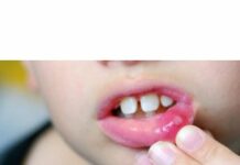 Как избавиться от язвочек во рту у ребенка? обсуждение на форуме