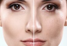 Лечение закрытых комедонов: эффективность косметических средств и аппаратных методик