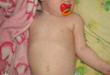 Розеола у детей симптомы: У нас все таки розеола фото, кому интересно все сюда, будете тоже знать, а кого была напишите сыпь прошла через сколько дней, розеола сначала появилась сыпь розеола у детей фото | Метки: симптом, лечение, детский, сыпать, симптом