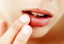 Увеличение паховых лимфоузлов при генитальном герпесе