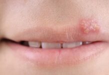 Диета при герпесе на теле, губах и генитальном герпесе — Поликлиника №8