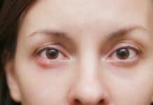 Ячмень на глазу при беременности — как и чем лечить