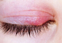 Какие мази помогают при ячмене на глазу?