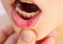 Все виды стоматита и их лечение — афтозный и герпетический стоматит