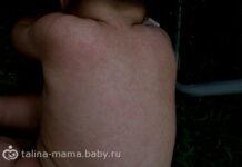 Симтомы и лечение детской розеолы: фото сыпи, причины, что это такое