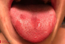Красные пятна на языке — причины и методы лечения