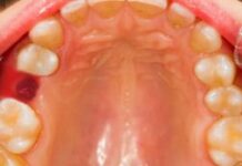 Гингивит у детей | симптомы, причины, чем лечить