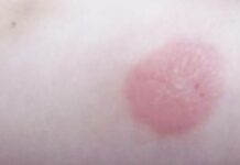 Что такое папула при манту