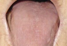 Проявления заболеваний внутренних органов на слизистой оболочке рта, языка и губ.