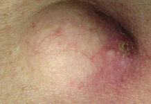 Атерома — что это и как это лечить? | Москва