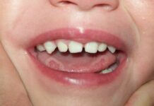 Язвы на языке у ребенка: причины, лечение заболеваний полости рта — Мед справочник