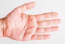 Лечение мокнущей экземы в клинике ПсорМак в Москве