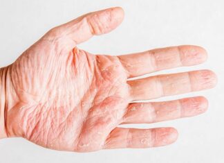 Лечение мокнущей экземы в клинике ПсорМак в Москве