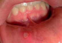 Что Делать Если Вышли Язвочки Во Рту