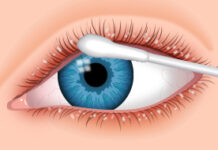 Чешуйчатый блефарит | причины, симптомы, лечение