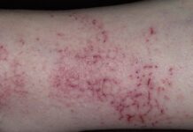 Гигиена при экземе