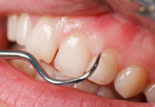 Воспаленная десна около зуба: как вылечить