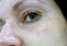 Отзыв о Биоревитализация | Много раз слышала о Биоревитализации и наконец опробовала на себе