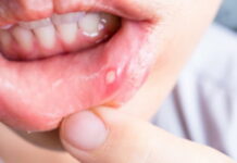 Афтозный стоматит — причины, симптомы, диагностика