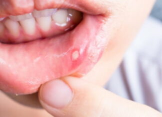 Афтозный стоматит — причины, симптомы, диагностика