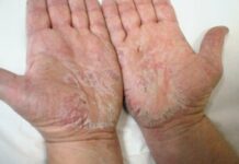 Дисгидротическая экзема кистей рук: причины, лечение, фото, дизгидроз на пальцах рук