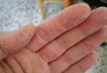 Экзема на пальцах рук — фото | Как лечить сухую экзему на пальцах рук у детей