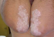 Экзема на локтях — фото начальной стадии, причины, лечение