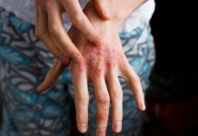 Псориаз: болезнь патрициев и плебеев