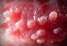 Перламутровые папулы на головке члена у мужчин, все причины — Про кожу