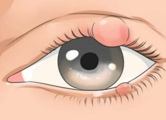 Ячмень: описание болезни, причины, симптомы, стоимость лечения в Москве | метро Полянка, Серпуховская, Добрынинская