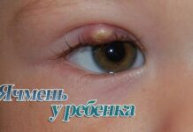 Ячмень на глазу у ребенка — как лечить; Городская детская поликлиника №1