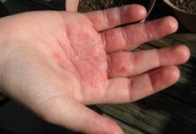 Чем лечить экзему на руках: ладонях, пальцах и кистях? Бурятская Республиканская станция переливания крови