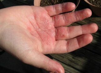 Чем лечить экзему на руках: ладонях, пальцах и кистях? Бурятская Республиканская станция переливания крови