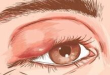 Ячмень на глазу при беременности — как и чем лечить — ОНЛАЙН БОЛЬНИЦА