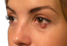 Халязион — цены на лечение, симптомы и диагностика халязиона век в «СМ-Клиника»