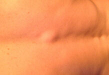 Уплотнение под кожей на спине — причины, фото, лечение — Про кожу