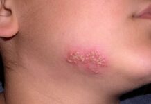 Герпес на подбородке: причины и быстрое лечение