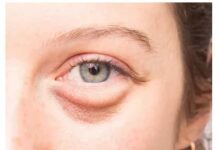 Отек века: описание болезни, причины, симптомы, стоимость лечения в Москве | метро Полянка, Серпуховская, Добрынинская