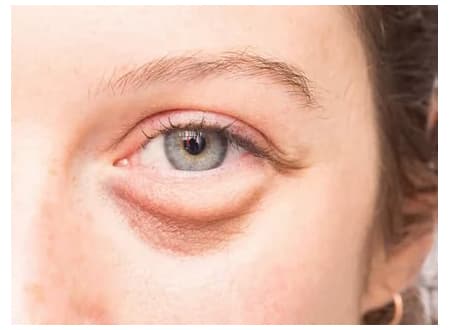 Отек века: описание болезни, причины, симптомы, стоимость лечения в Москве | метро Полянка, Серпуховская, Добрынинская