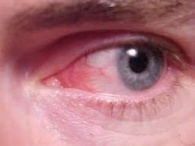 Аллергический коньюктивит.