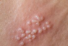 Вирус простого герпеса — лечение, симптомы и причины возникновения