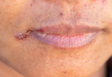 Заеды в уголках рта — причины появления, при каких заболеваниях возникает, диагностика и способы лечения
