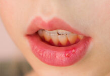 Лечение афтозного стоматита, виды, причины и симптомы. Способы лечения