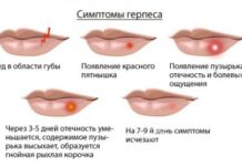 Как быстро убрать простуду на губах — Receptika Интернет аптека