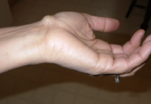 Шишки под кожей по всему телу на руках и ногах: главные причины, симптомы и визуальные признаки, диагностика новообразований, способы лечения, хирургическое удаление