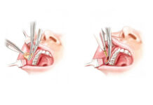 Удаление комков Биша — цены, фото до и после