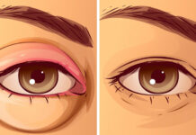 Отечность век — причины появления, при каких заболеваниях возникает, диагностика и способы лечения