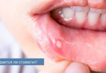 Передается ли стоматит?