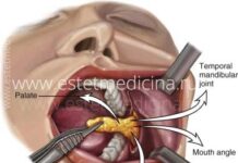 Удаление Комков Биша: операция — пустышка? Настоящие отзывы хирургов | Интернет-журнал